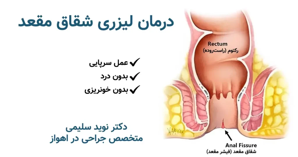 جراحی شقاق با لیزر در اهواز - دکتر نوید سلیمی