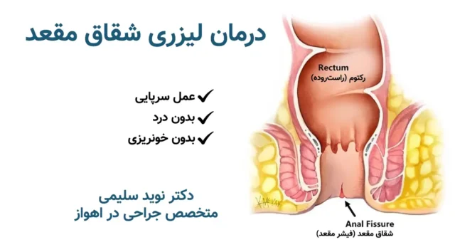 جراحی شقاق با لیزر در اهواز - دکتر نوید سلیمی