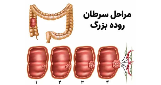 مراحل سرطان روده بزرگ؛ علائم، تشخیص و درمان