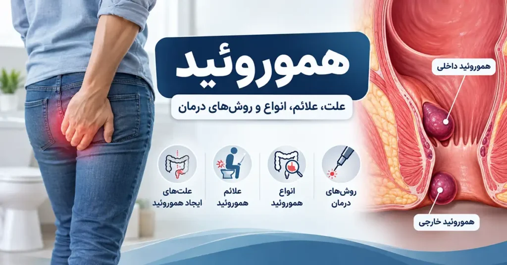 هموروئید چیست؟ علت، علائم و درمان بواسیر