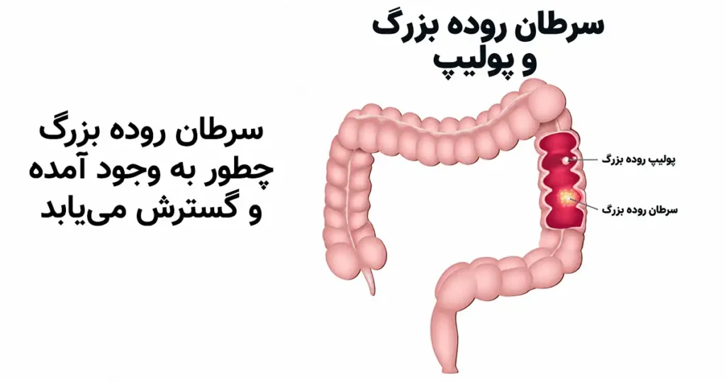 سرطان روده بزرگ چگونه شروع می‌شود؟ از پولیپ تا تومور