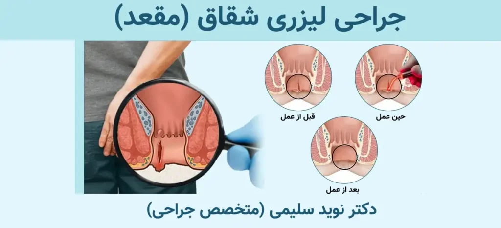 جراحی لیزری شقاق مقعدی؛ قبل، حین و بعد از عمل