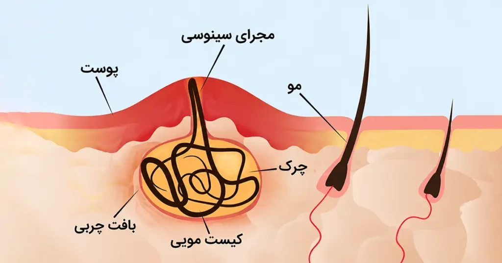 آناتومی کیست پیلونیدال؛ ساختار و محل تشکیل کیست مویی