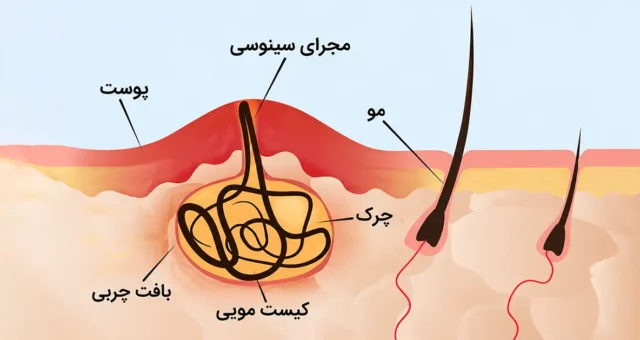 آناتومی کیست پیلونیدال؛ ساختار و محل تشکیل کیست مویی